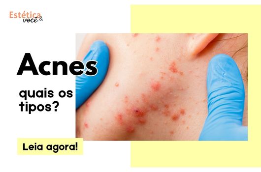 EEV - Acnes - capa