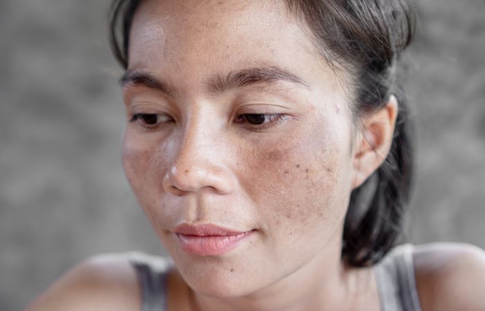 EEV - Melasma - corpo