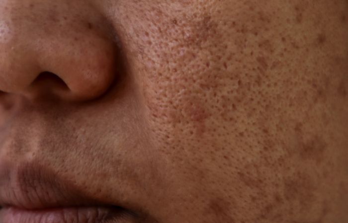 EEV - Melasma - corpo 1